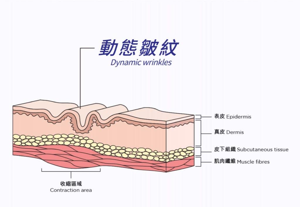 顯示動態皺紋的皮膚結構圖，標示表皮、真皮、皮下組織和肌肉纖維的解剖，強調動態皺紋的形成機制，適合對皮膚美容及護理有興趣的受眾。