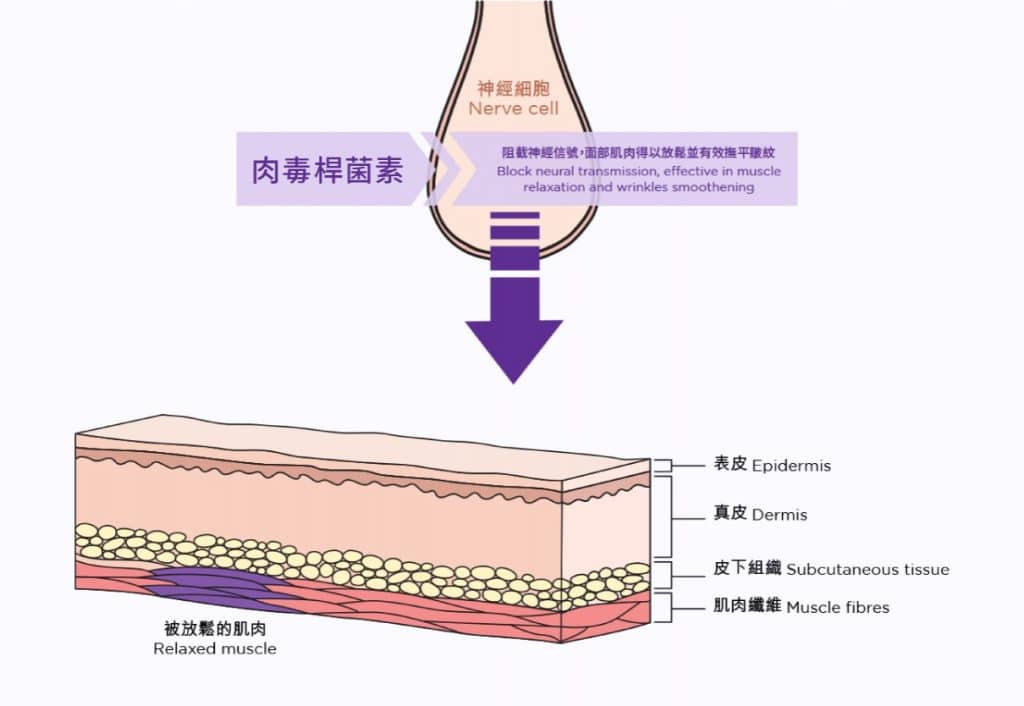 展示肉毒桿菌素的作用機制，顯示神經細胞與肌肉的關係，強調肉毒桿菌素如何阻止神經傳遞以達到肌肉放鬆和皺紋平滑的效果，適合美容療程的介紹。