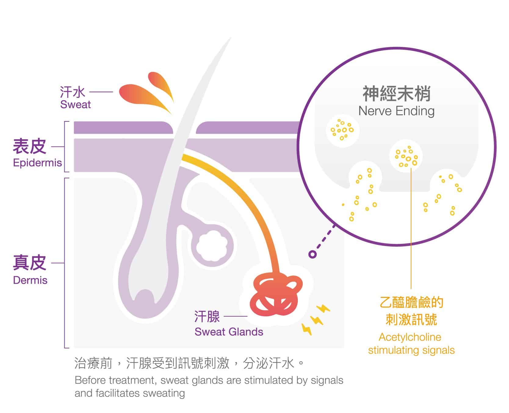 圖解說明治療前汗腺的運作，顯示神經末梢如何刺激汗腺分泌汗水，強調Botox療程的作用機制。