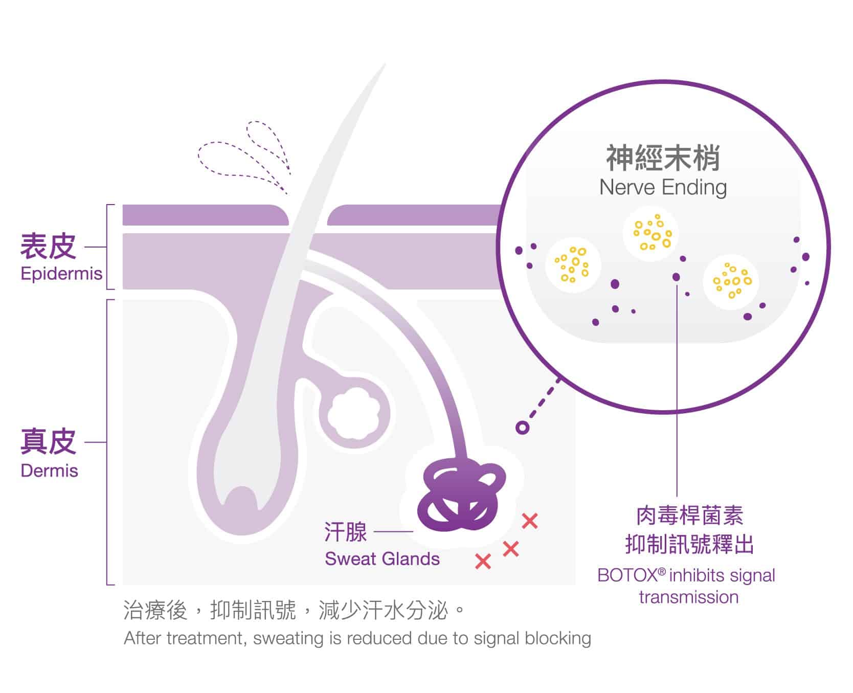 圖解說明治療後的效果，展示Botox如何抑制神經信號，減少汗水分泌，適合對止汗療程感興趣的消費者。