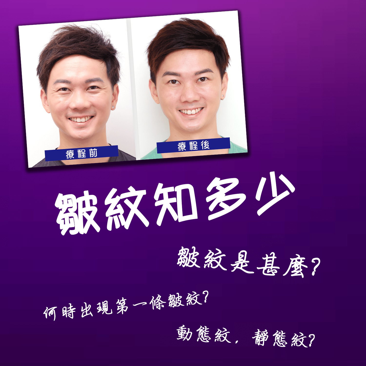 四張面部療程前後的對比圖片，左側為療程前的表情，右側為療程後，顯示出明顯的改善和年輕化效果。背景有關於皺紋和療程的問題，吸引觀眾的注意。
