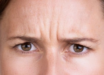 xeomin-肉毒桿菌素-before