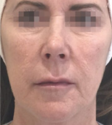 profhilo-肌底細胞活化-after