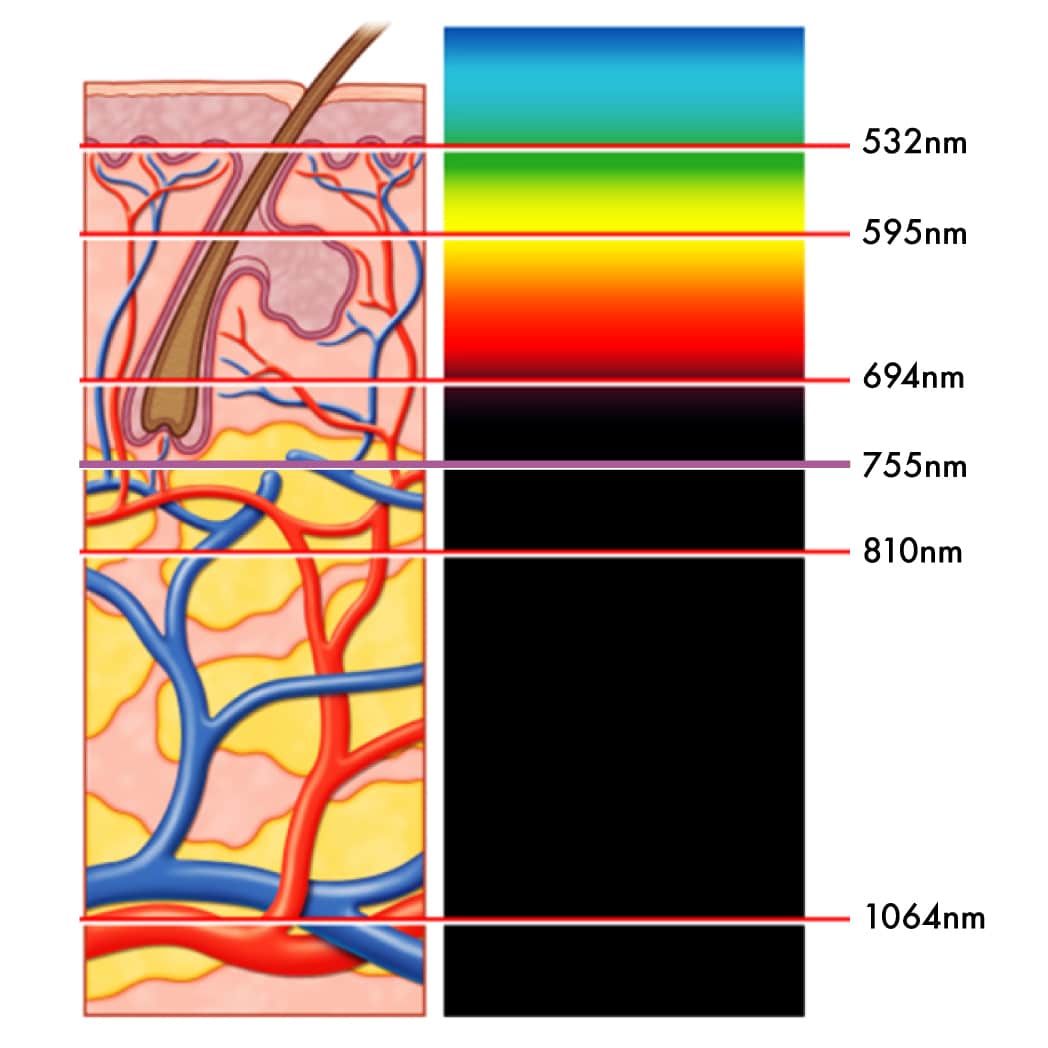 示意圖顯示不同波長（532nm、595nm、694nm、755nm、810nm、1064nm）激光如何穿透皮膚，並影響血管和毛髮，適合用於激光脫毛和皮膚治療的教育資料。