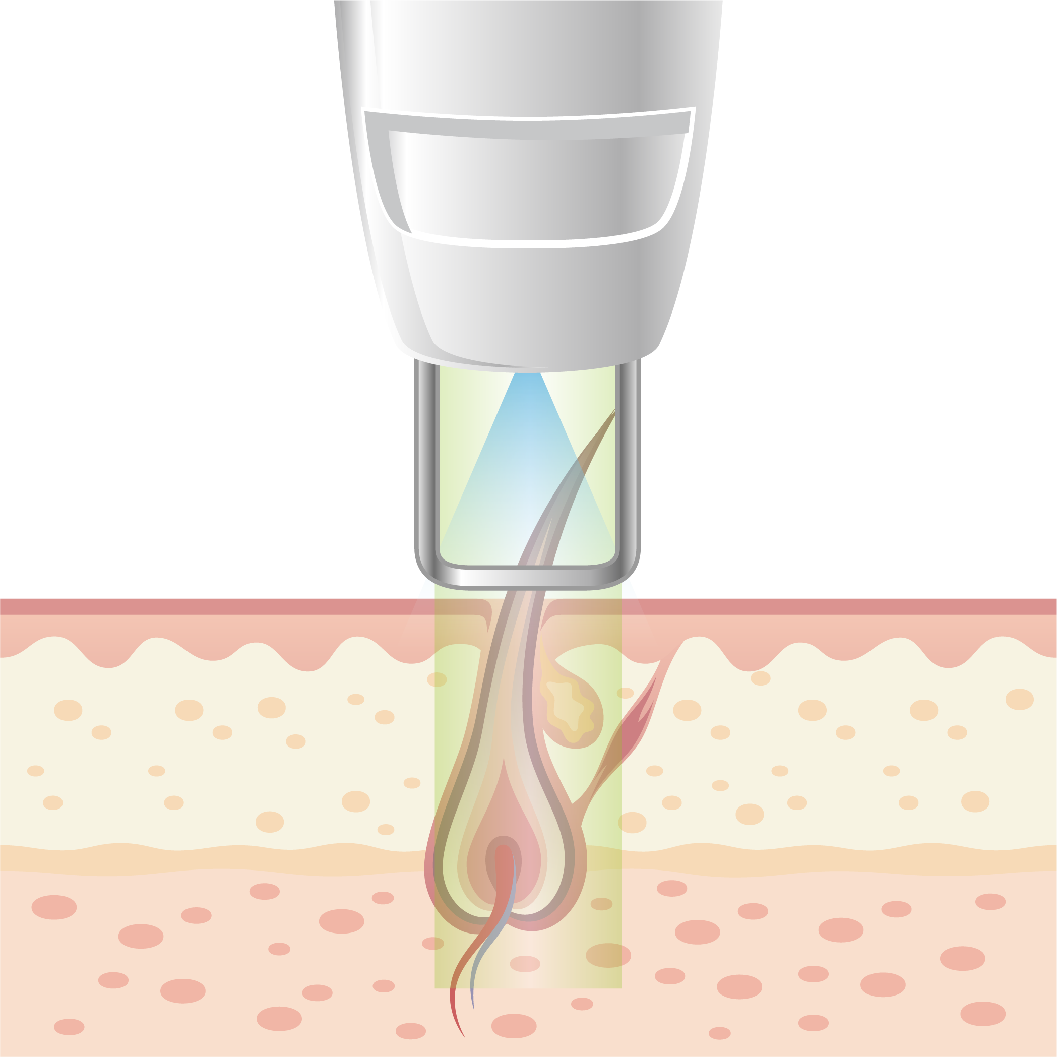 激光設備正在針對毛髮進行治療，顯示激光束如何穿透皮膚，針對毛囊進行作用，適用於脫毛過程的示意圖。