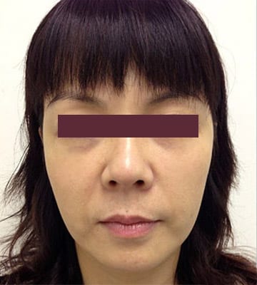 derma-veli-童顔針-before