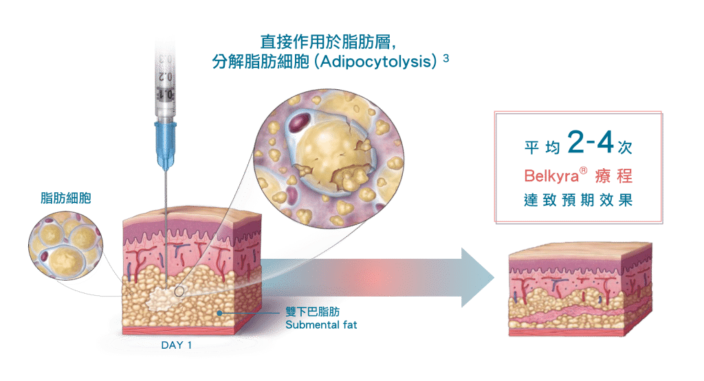belkyra雙下巴治療過程示意圖，顯示注射器進入皮膚層，脂肪細胞溶解過程，標註治療時間及效果。