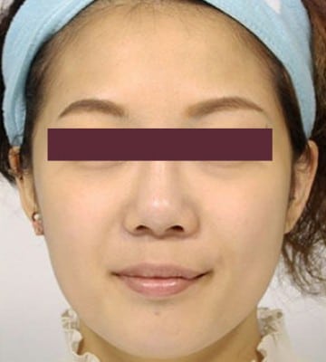 derma-veli-童顔針-after2