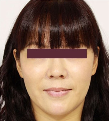 derma-veli-童顔針-after