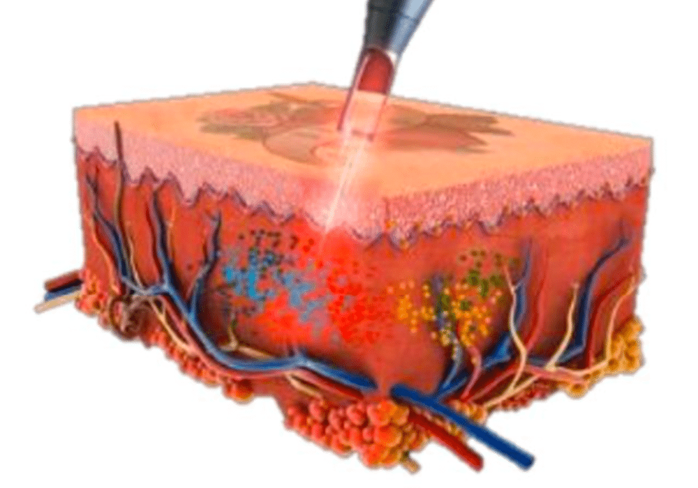 皮秒激光治療過程的示意圖，激光能量進一步滲透進皮膚，針對色素與膠原蛋白進行有效治療。
