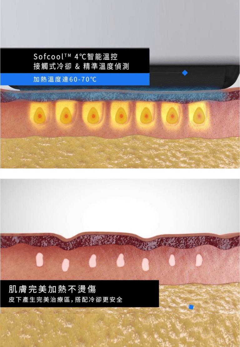 介紹Sofcool™ 4°C智能溫控技術，展示其冷卻系統及加熱過程，強調皮膚在治療過程中的安全性與舒適度。