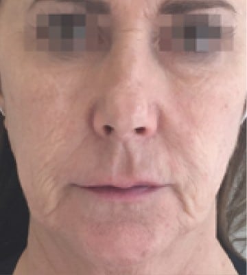 profhilo-肌底細胞活化-before