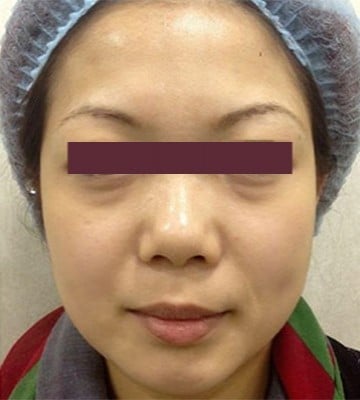 derma-veli-童顔針-before2