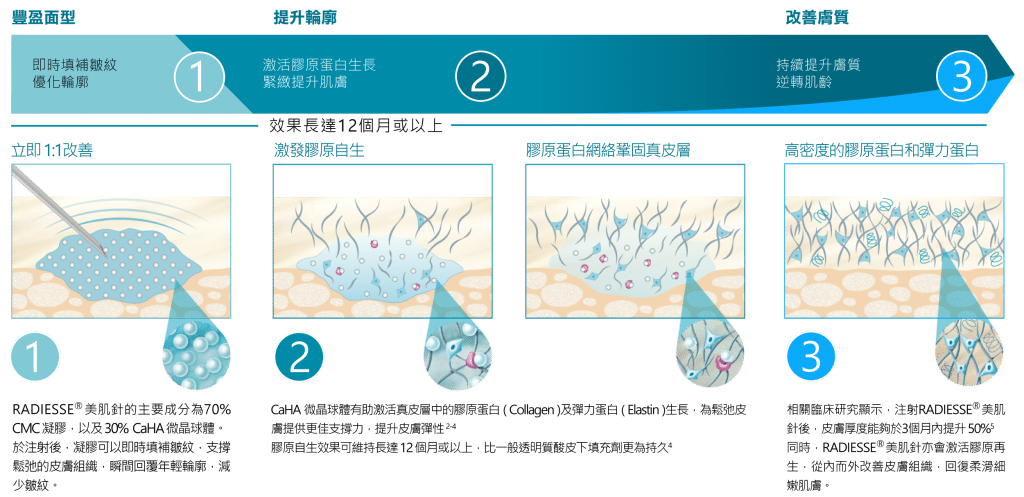 展示RADIESSE美肌針的三個主要療效流程圖，包含即時豐盈、提升輪廓及改善膚質的步驟，強調治療效果的連貫性。