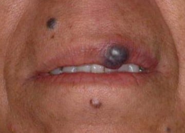 cutera-退紅激光-before