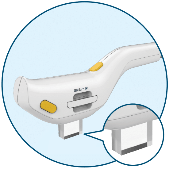 展示Stellar IPL手把的特寫，突顯其設計及功能，說明該設備在進行脈衝光治療中的應用。