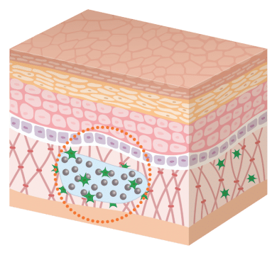皮膚結構的3D示意圖，突顯特定區域的細胞活動，展示細胞在皮膚層中的作用，適合用於美容醫學的解釋。