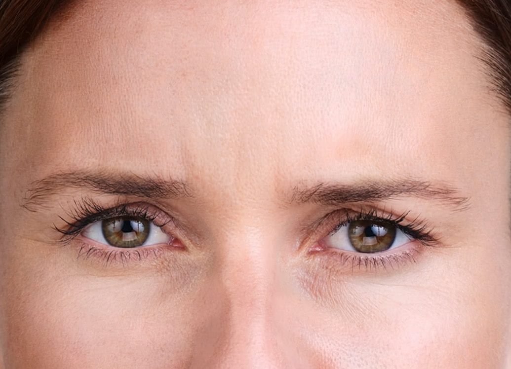 xeomin-肉毒桿菌素-after