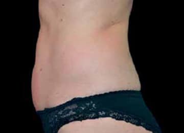 exilis-ultra-360-定位消脂修形-after