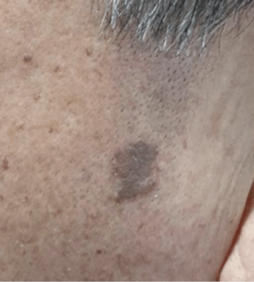 lhalala-peel-fill-before2